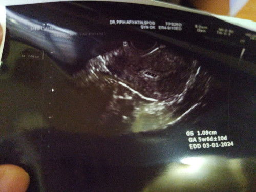 Hasil usg kantung mengkerut atau mengecil