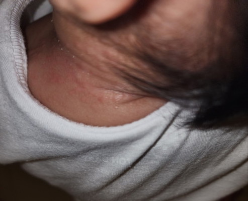 Rashes sa leeg?
