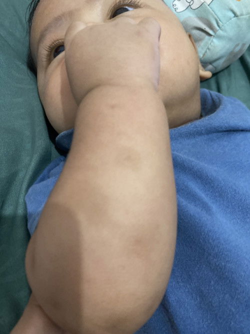 Lotion penghilang bekas gigitan nyamuk