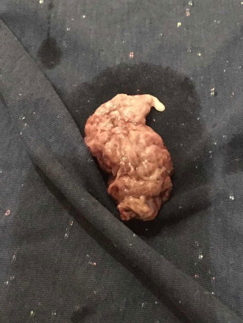 Keluar Gumpalan aneh saat hamil 13week