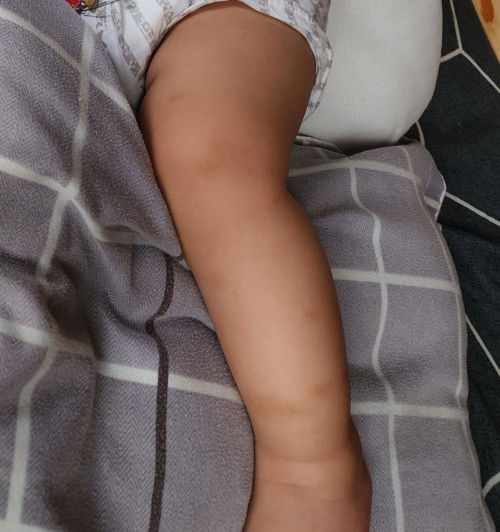 Treatment for dark spots sa skin ni baby