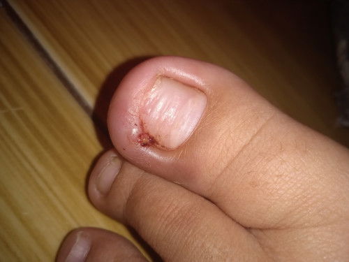 Cantengan di jempol kaki