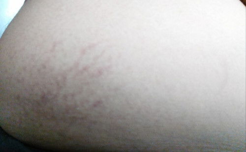 ครีมตัวไหนที่จะแก้ท้องแตกลายได้บ้าง