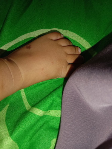 beruntusan di kaki