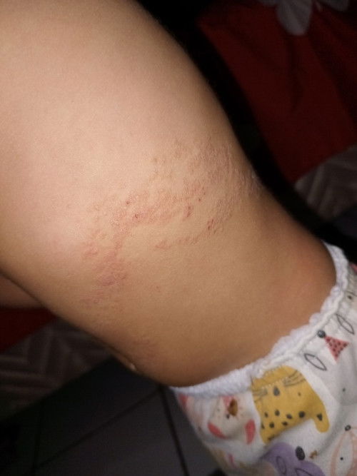 Kulit kering bersisik gatal bayi