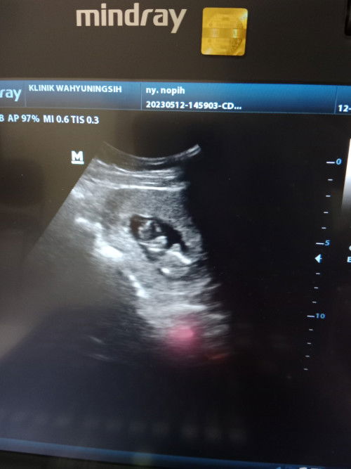 Apa kah USG in bener usia 11w