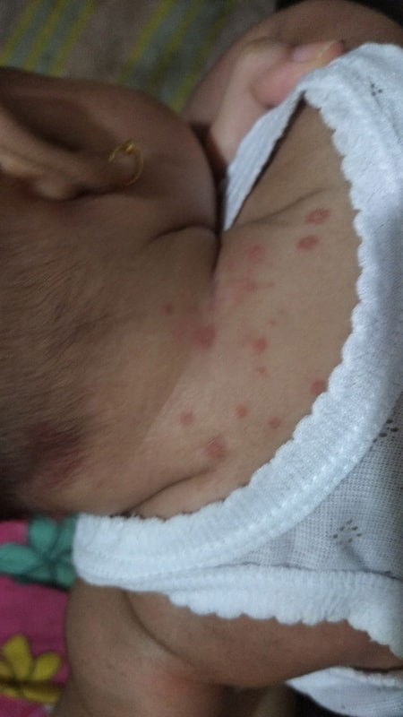 Apakah ini termasuk cacar