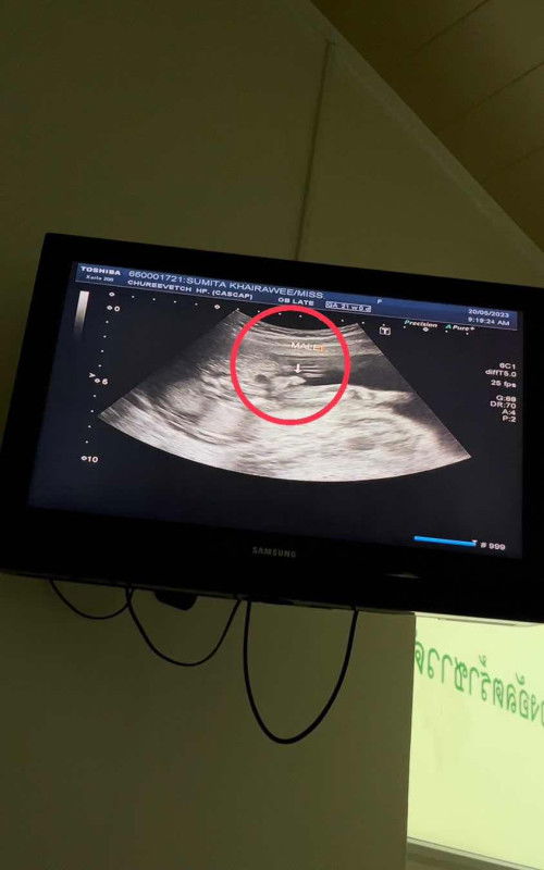 ดูเพศช่วยหน่อยค่ะ คุณหมอยังไม่คอนเฟิร์ม