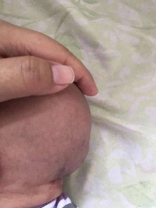 Benjolan keras di kepala newborn