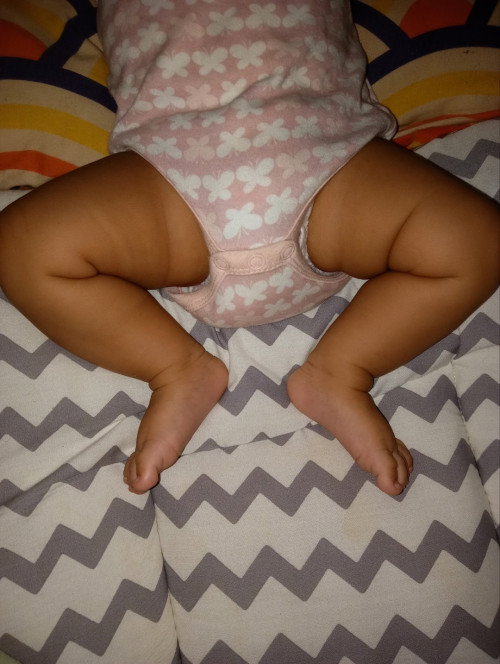 Worry nih Bun takut Hip dysplasia