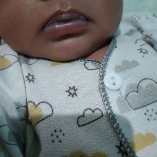 Bibir bayi putih seperti melepuh