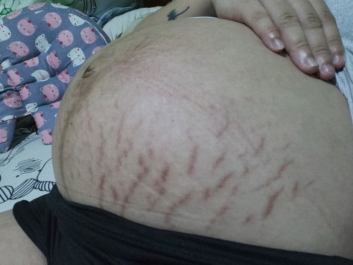 Stretch marks