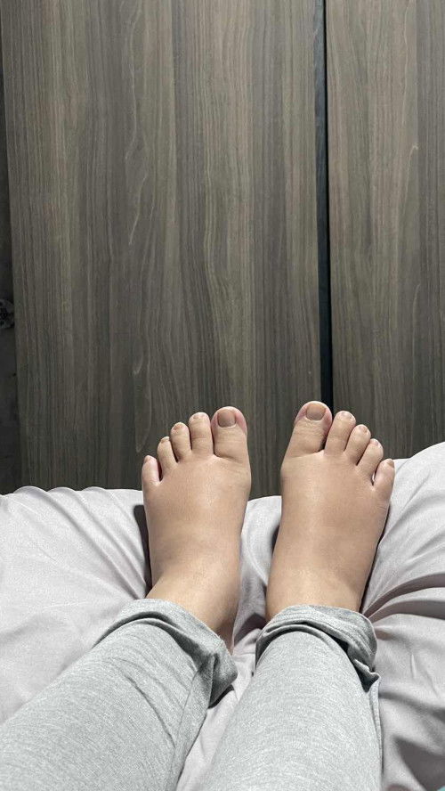 Swollen feet