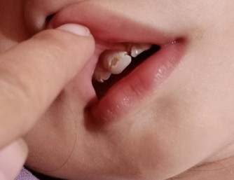 crack teeth/ Baby teeth