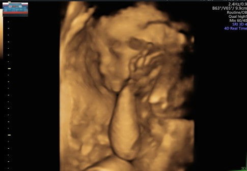 Kehamilan 27w5d hpl Agustus