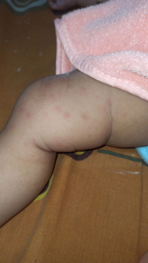 Gatal² di kaki dan tangan 🥺