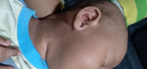 Cara hilangkan putih-putih di leher