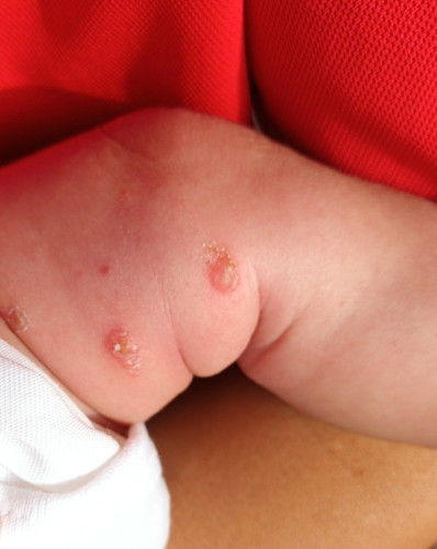 Heat rash o infection?