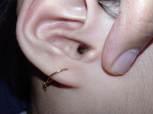 Kotoran telinga anak mengeras