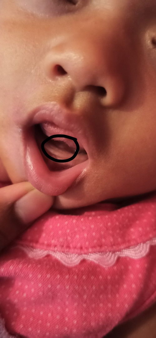 Benjolan belakang gusi