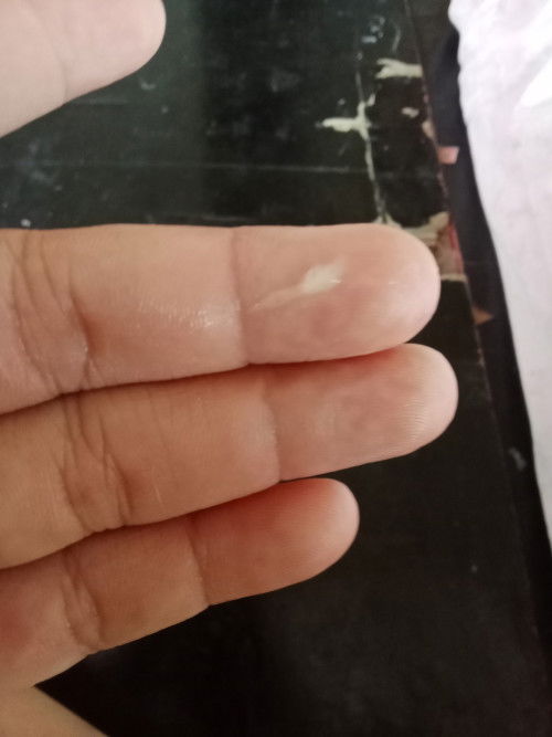 33+6มีมูกไสออกมาแบบนี้เปนอะไรรึป่าวคะ