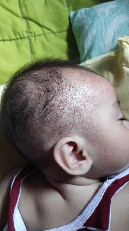 Ano po pwedeng gamot ?