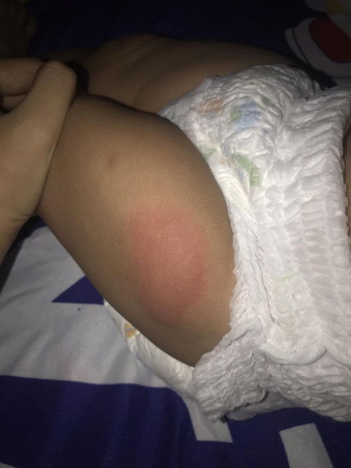 ผื่นขึ้นขา