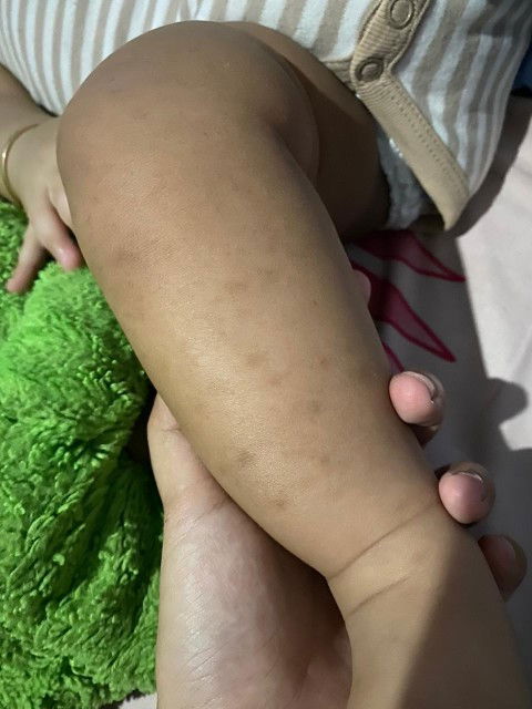 Bekas gigitan nyamuk menghitam