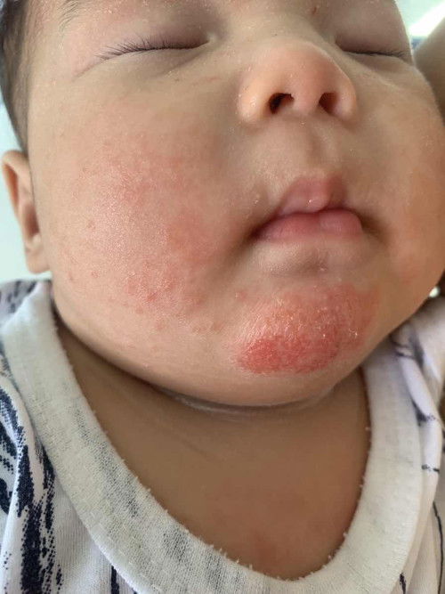 น้องแพ้อะไรทายาไม่หายสักที