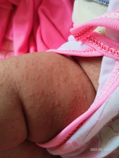 Bintik merah , biang keringat pada bayi 2 bulan