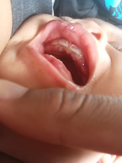 แม่ๆไหนพอรู้บ้างคะน้อง 1 ขวบค่ะไปพบทันตแพทย์มาแล้วแต่ทันตแพทย์บอกว่าเป็นเหงือกอักเสบเป็นใต้ฟัน2ซี่