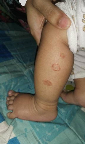 Anak sering menggaru - garu , gatal . Sebelum ni cuba letak cream youbaby & cetaphill. Masih begini.