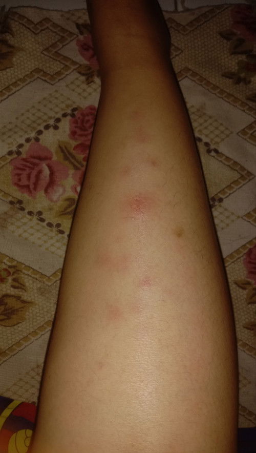 Timbul memar memar tulang betis kiri dan kanan, awalnya cuma satu lama lama semakin banyak.