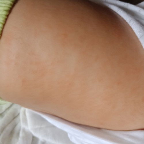 Bé nổi mẩn đỏ