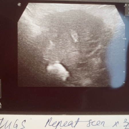 Scan pregnancy confirmation