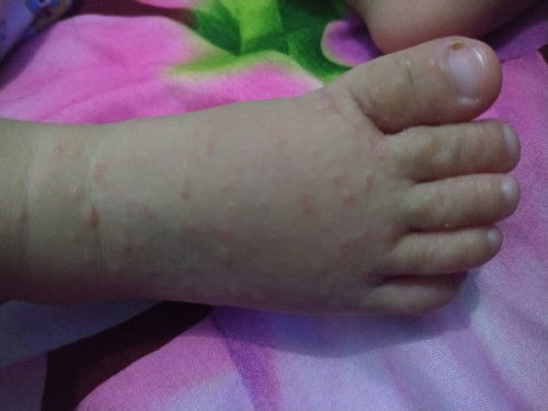 Anakku 9 bulan, dikaki kanan muncul bentol2 seperti itu, penanganannya gmn ya bun?