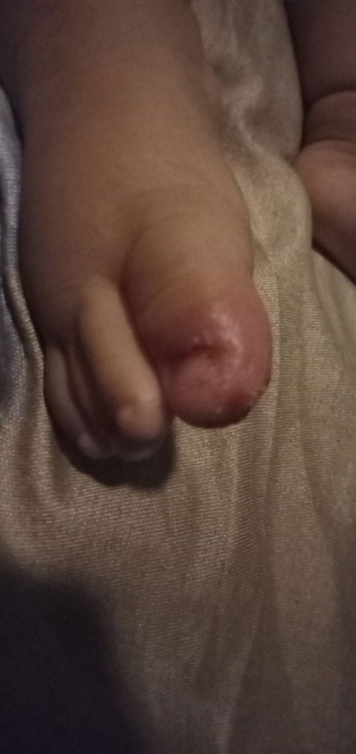 Mga Mii Anu pong gamot sa sugat nilalangasan ko po so l.o ng dahon bayabas,nagkasugat sya sa walker