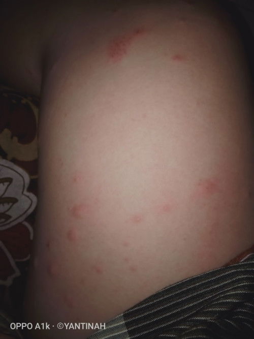 gatel² seluruh badan