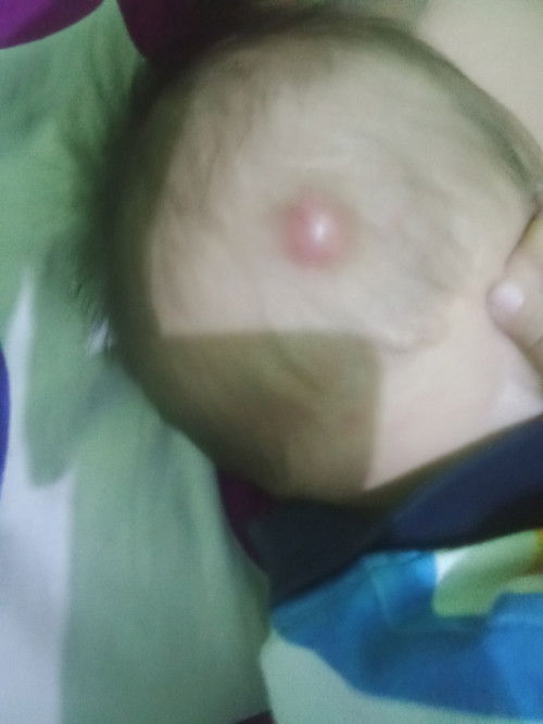 Assalamu'alaikum bunda, ada yang tau kah ini bisul atau apa?