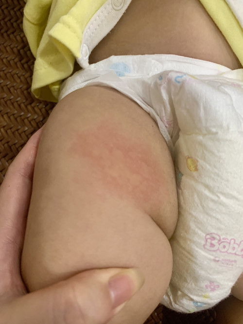 Bé gần 4 tháng bị nổi mụn