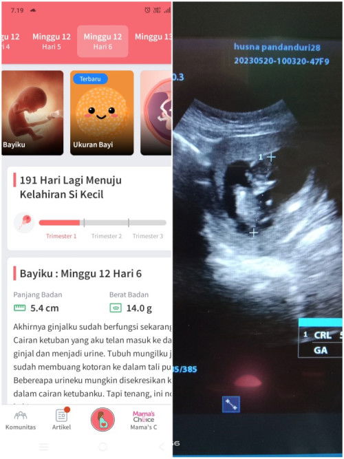 Hpl berbeda dengan hasil USG