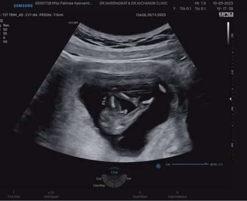 แม่ๆ รู้เพศลูกกันตอนกี่เดือนค่ะ