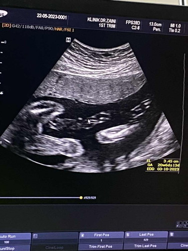 24 weeks jantina belum confirm