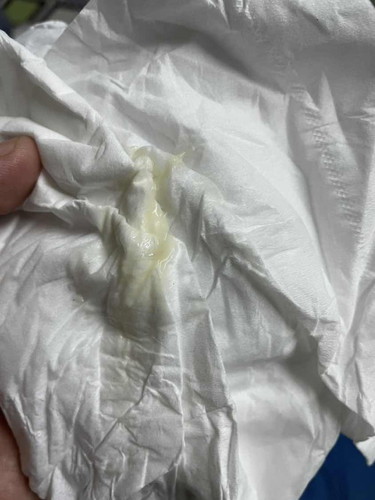 ตกขาวใช่ไหมคะ