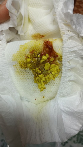 รบกวนถามค่ะ ลูกถ่ายมีมูกเลือดแบบนี้ หมอบอกไม่เป็นไร เดี๋ยวหายเอง