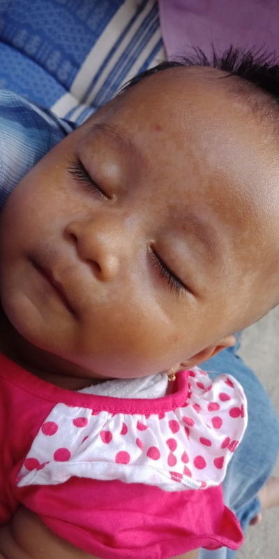bercak putih di wajah bayi