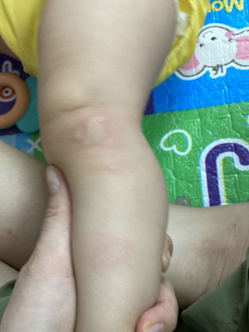 Bs bảo bé bị đay dị ứng