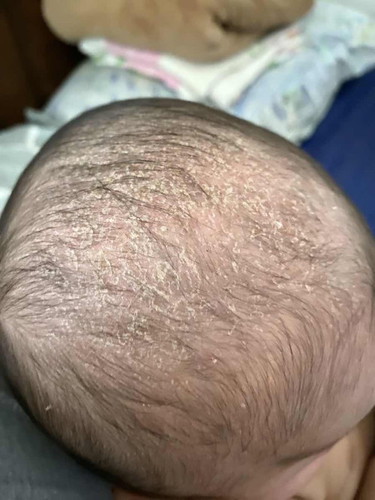 Cradle Cap
