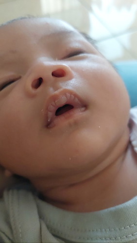 Jamur pada bibir bayi