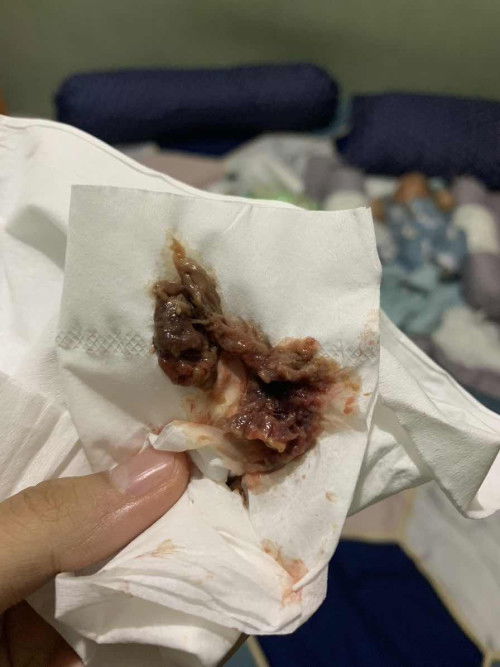 Keluar gumpalan seperti daging busuk